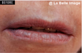 リップホワイトニングセッション前3